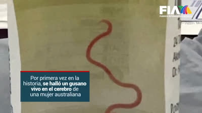 Descubren un gusano vivo en el cerebro de una mujer australiana
