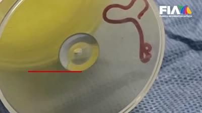 Impactante descubrimiento: Gusano vivo extraído del cerebro de mujer australiana