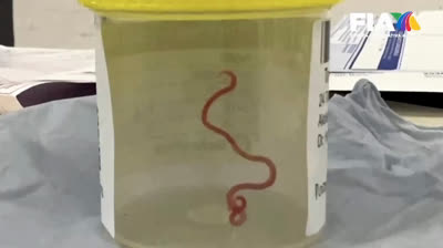 Gusano vivo encontrado en el cerebro de mujer australiana aquejada de extraños síntomas