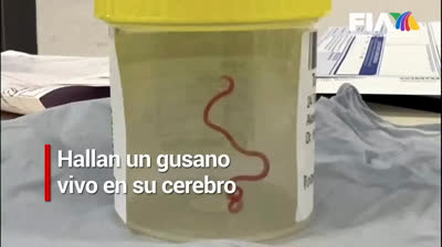 Extraordinario hallazgo: Parásito vivo hallado en el cerebro de mujer de Australia